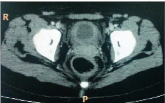 Figure 1. Computed tomography demonstrated thickening of the  bladder wall with marked reduction of its filling capacity.