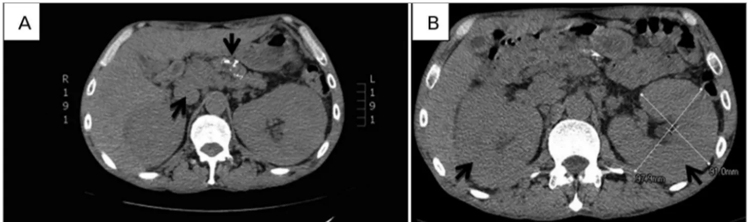 Figure 1. Total abdomen computed tomography scan without contrast. A. Enlarged paraaortic lymph nodes and calcifications in pancreatic tissue