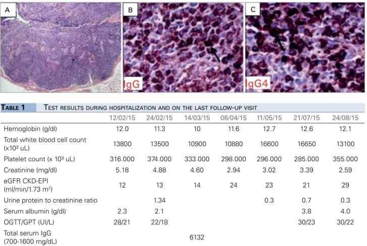 Figure 3. Lymph node biopsy positive for IgG4. A. Parafollicular expansion presenting mixed lymphoid population and various aggregates of  polyclonal plasma cells with areas of fibrosis