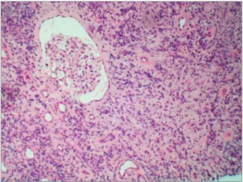 Figure 2. IgG4 tubulointerstitial nephritis: Kidney parenchyma  exhibiting a dense interstitial lymphoplasmacytic infiltrate and  storiform fibrosis, with normal glomeruli, hematoxylin-eosin, 100x.