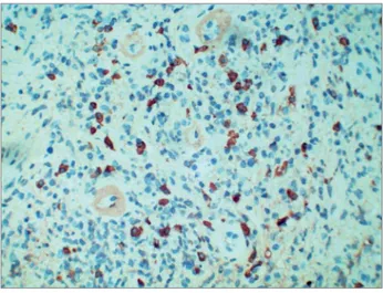 Figure 4. IgG4 tubulointerstitial nephritis: IgG4 positive plasma cells  in kidney interstitium, streptavidin-peroxidase polymer, 200x.