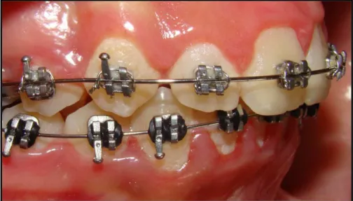 Figura  1.  Gengivite  associada  a  tratamento  ortodôntico  e  higiene  oral  deficiente