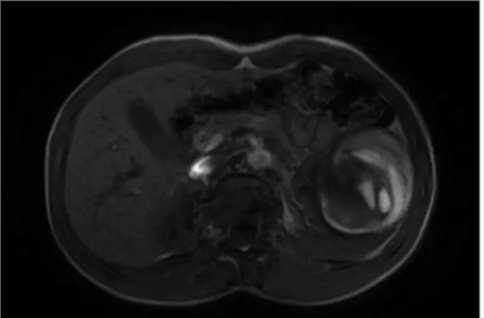Figure 4. Evidence of decrease in cyst size, now measuring  3.6x3.4x2.3cm in the greater longitudinal, cross-sectional, and  anteroposterior.