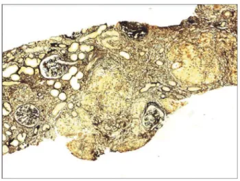 Figura 4. Seção histológica renal com aglomerado intersticial de  histiócitos epitelioides e célula gigante multinucleada (PAS - 100x).