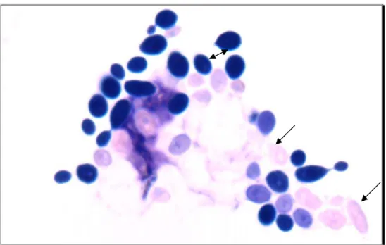 FIGURA 1 – Macrófago M1 (camundongos C57BL/6) em contato com capilares vazios,  apresentando leveduras fagocitadas em tom rosa (vide seta) e leveduras aderidas em tom violeta  (vide seta dupla)