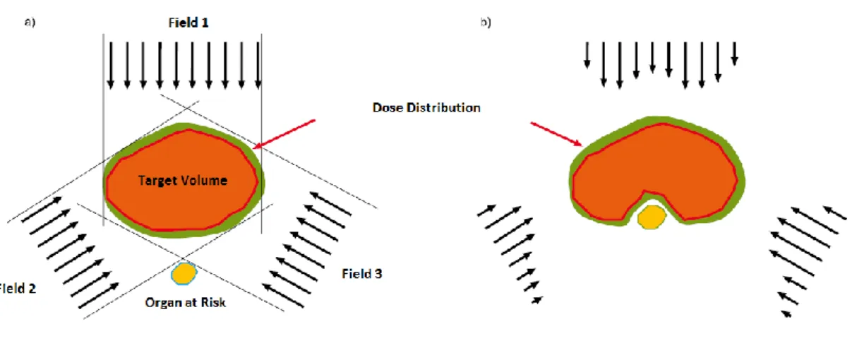 Figure 2.9 – a) 3D Conformal RT technique using uniform beams; b) IMRT technique using non uniform beams [17]