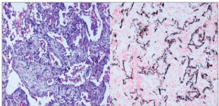 Figura 1. À esquerda (aumento de 40x), coloração de hematoxilina- hematoxilina-eosina: espessamento intersticial importante por células com  citoplasma claro, associada à hiperplasia de pneumócitos tipo 2 e  alguns focos de calcificação