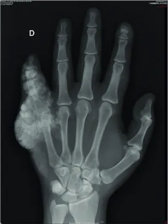 Figure 1. Right hand X-ray: Multiple calcifications around the phalanges  and the phalangeal-metacarpal transition of 5th right hand finger.