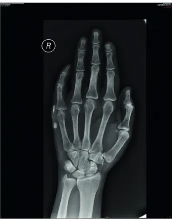 Figure 2. Right hand X-ray after 4 months of the transference of the  patient to hemodialysis showing markedly reduction of UTC.