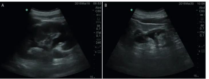 Figure 4. Intravesical Foley catheter.