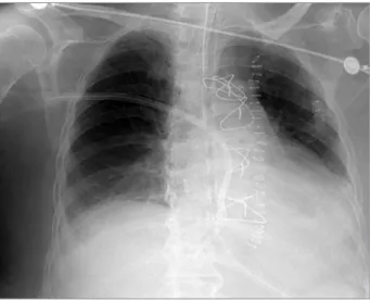 Figure 2. Post-procedure chest radiograph showing direct intra-atrial  catheter in place.