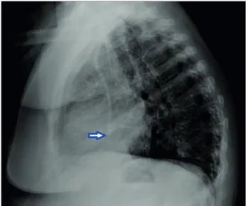 Figure 1. Chest X-Ray showing dialysis catheter tip located in the  inferior vena cava (blue arrow).