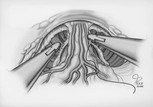 Figure 1 – Two 2-0 vicryl sutures in a CT-1 needle are used to effectively ligate the dorsal vein complex.