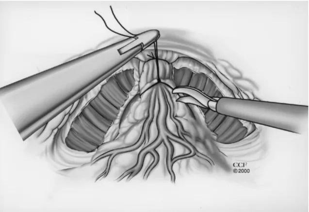 Figure 2 – Anterior traction on the back bleeding stitch helps to identify the appropriate plane of dissection between the prostate base and the bladder.