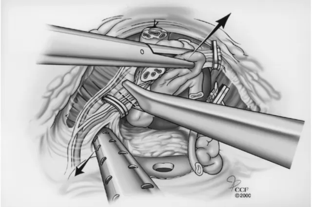 Figure 3 – During a nerve-sparing procedure, the lateral pedicles are defined and controlled with non-metallic locking clips.