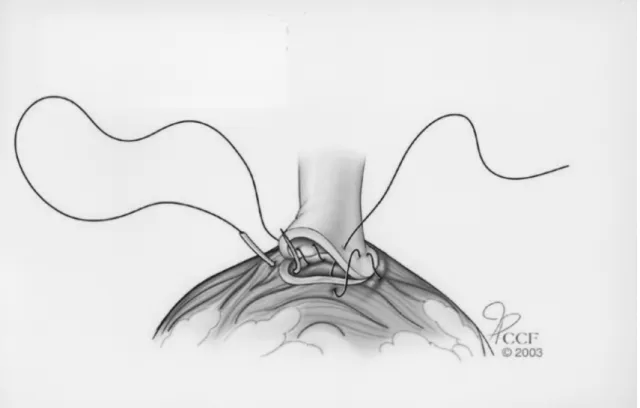 Figure 4 – Under laparoscopic visualization a precise mucosa-to-mucosa approximation is completed using running sutures.
