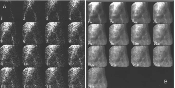 Figure 4 – Correlation between scintigraphy and biopsy results.