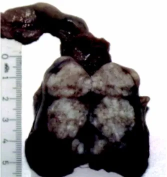 Figure 1 – Orchiectomy specimen longitudinally opened, demonstrating lobulated tumoral tissue.