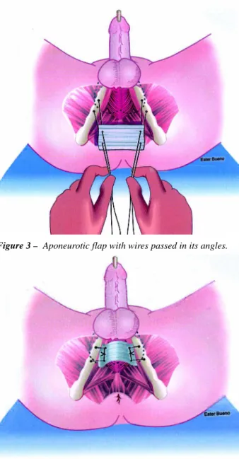 Figure 1 – Longitudinal perineal incision.