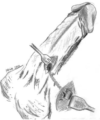 Figure 4  –   Winter-shunt (percutaneous glandulocavernous shunt with a True-Cut-Needle)