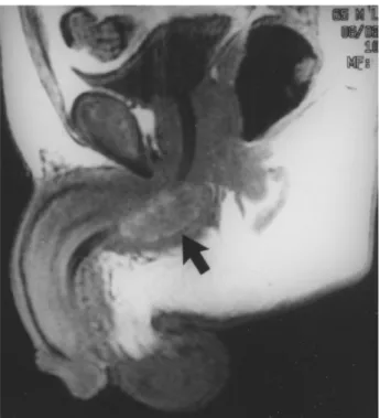 Figure 1 – Nuclear magnetic resonance imaging showing ure- ure-thral metastatic lesion (arrow).