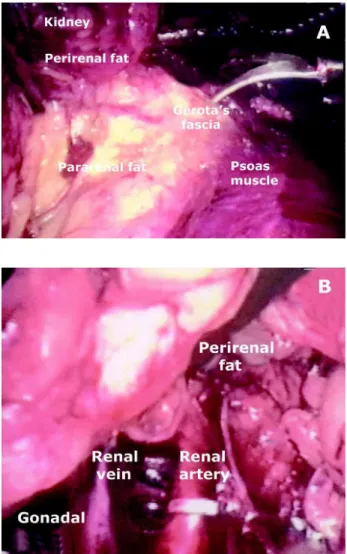 Figure 6  –  Anatomic repairs in lumbar access (endoscopic view).