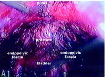 Figure 8 – Anatomic repairs in pelvic access (endoscopic view).