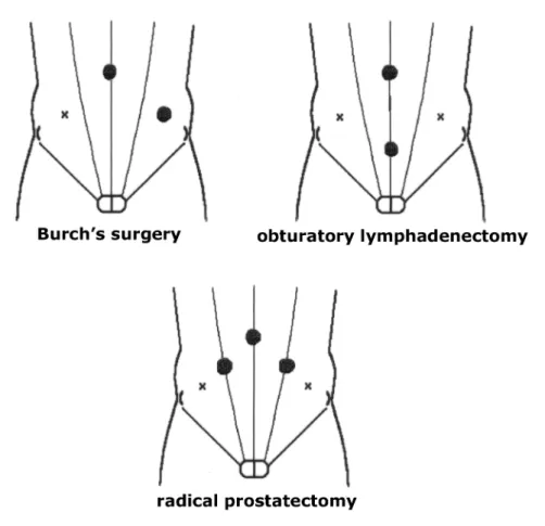 Figure 9 – Positioning of the ports in the pelvic region according to the procedure.      = 10 mm port; x = 5 mm port.