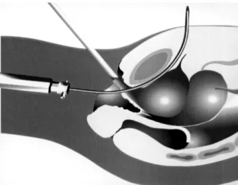 Figure 3 - SAFYRE TM  is attached to the needle and pulled out to the suprapubic area.