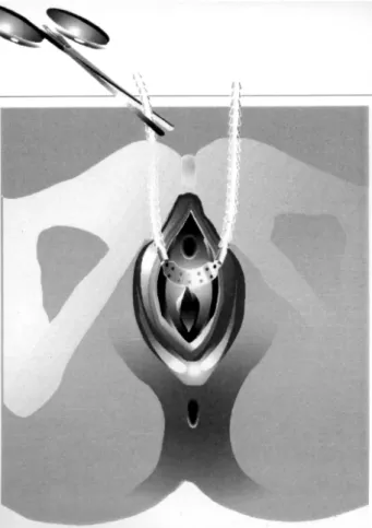 Figure 4 - A Metzenbaum scissors is placed between the tape and the urethra for proper tension adjustment.