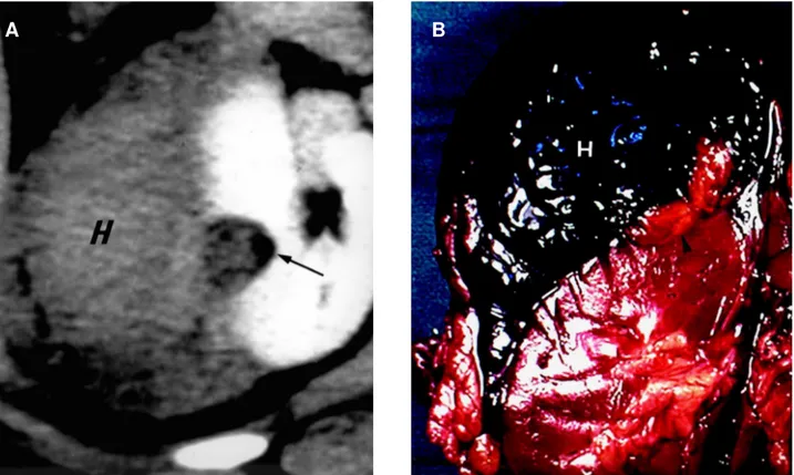 Figure 1 - Small ruptured angiomyolipoma associated with spontaneous renal hemorrhage