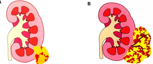Figure 4 - Diagrams illustrating the 2 variants of pattern-II (partially fatty) angiomyolipoma