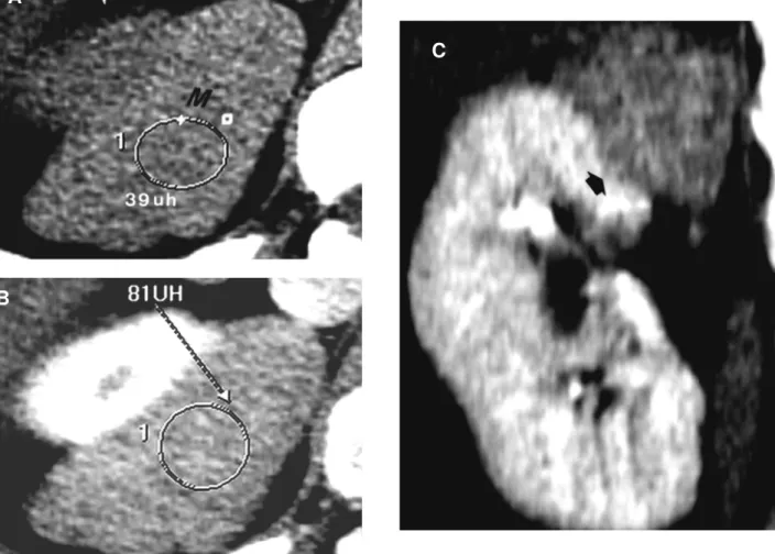 Figure 9 - Pattern-IV angiomyolipoma mimicking RCC. A) - Nonenhanced CT scan shows a homogeneously hyperattenuating (39 HU), exophytic mass (M), at the posterior aspect of the upper pole of the right kidney