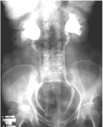 Figure 2 – Excretory urography evidencing bilateral hydroneph- hydroneph-rosis due to vaginal prolapse.