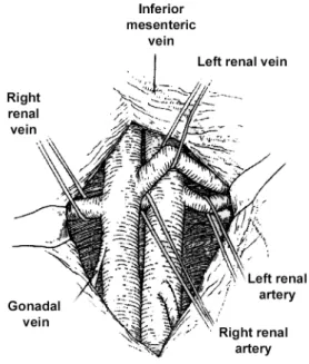 Figure 3 - Anatomic relationship of the renal vessels. (Reprinted with permission from: McAninch JW: Surgery for Renal Trauma.