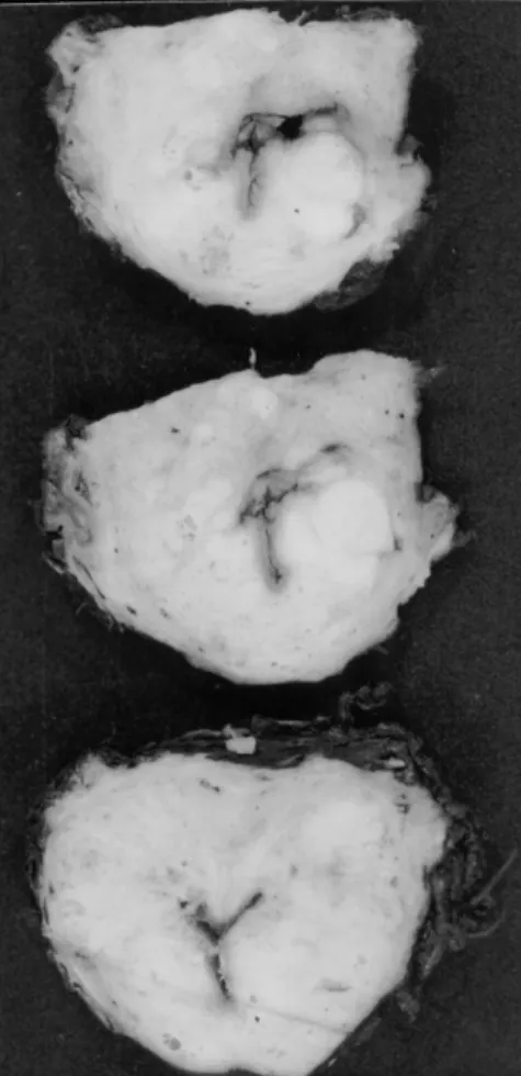 Figure 2 - The prostate slices were subdivided into quadrants and labeled to allow for reconstruction as whole-mount sections.