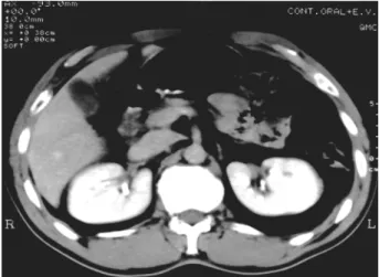 Figure 2 – Abdominal computerized tomography with venous contrast, performed 5 months after thrombolytic therapy,  re-vealing total reperfusion of both kidneys.