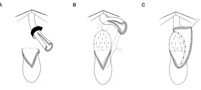 Figure 3 (A to C) - Augmented roof strip anastomotic urethroplasty.