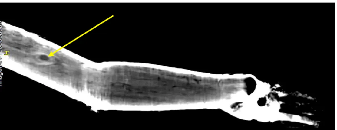 Fig. 26 - Corte coronal do braço esquerdo. Nó atravessa toda a sua espessura.