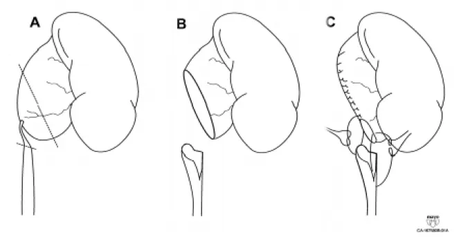 Figure 1 - Anderson-Hynes pyeloplasty.