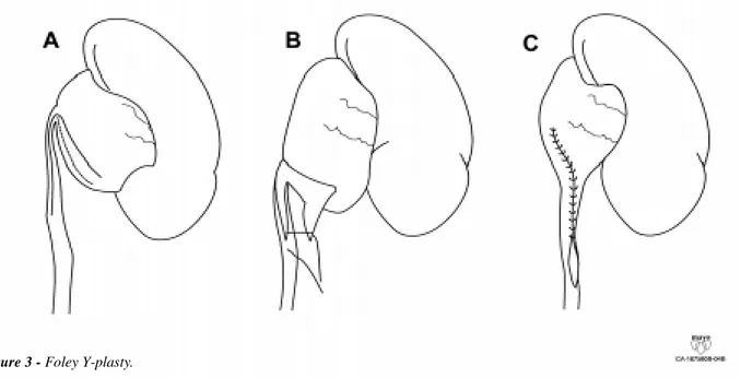 Figure 3 - Foley Y-plasty.