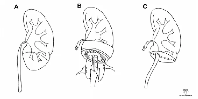 Figure 5 - Complex ureterocalycostomy.