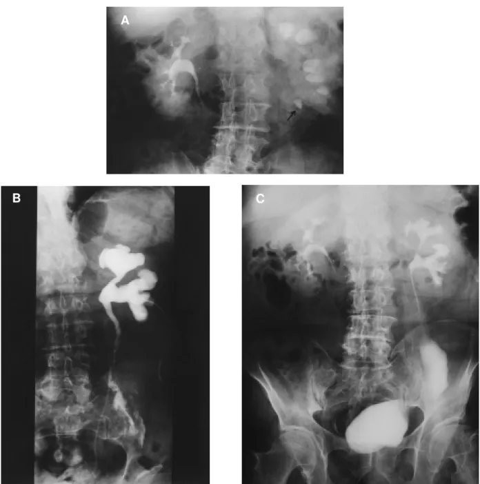 Figure 1-  A) Intravenous pyelography (IVP) showing a 5x11 mm calculus located in the upper third of the left ureter, determining severe upper urinary tract obstruction