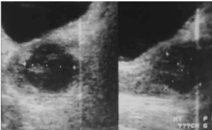 Figure 2 – Pelvic computed tomography showing an abscess in the prostate.