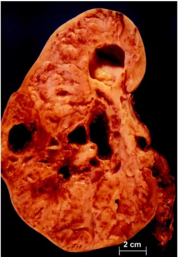 Figure 1 - Angio-MRI demonstrating renal mass and thrombo- thrombo-sis of the right renal vein.