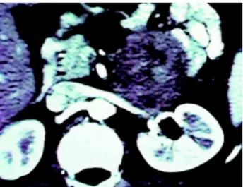 Figure 2 – Surgical specimen. A) - Place of tumor origin near the left renal vein wall