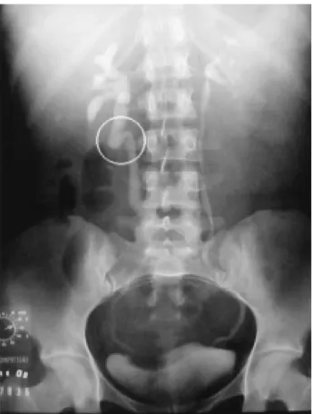 Figure 1 – Intravenous pyelogram showing dilation and tortu- tortu-osity of the upper ureter (circle) and dilation of the  right pyelocalyceal system.