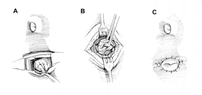 Figure 1 - Blocksom vesicostomy. A) The skin, rectus fascia, and muscle are divided. The urachus is identified and pulled into the wound