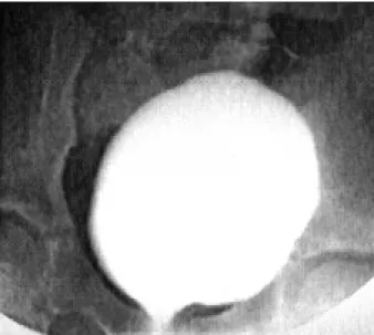 Figure 2 - Radiograph during the filling phase showing open bladder neck.