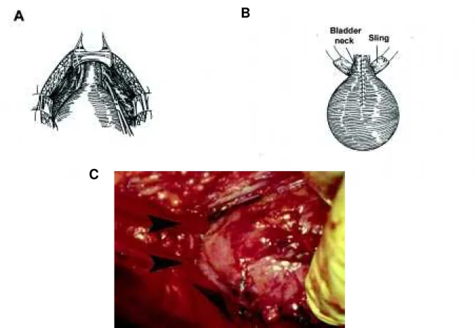 Figure 4 -  Placement of the fascial sling around the bladder neck. A) Diagram showing incision of the endopelvic fascia